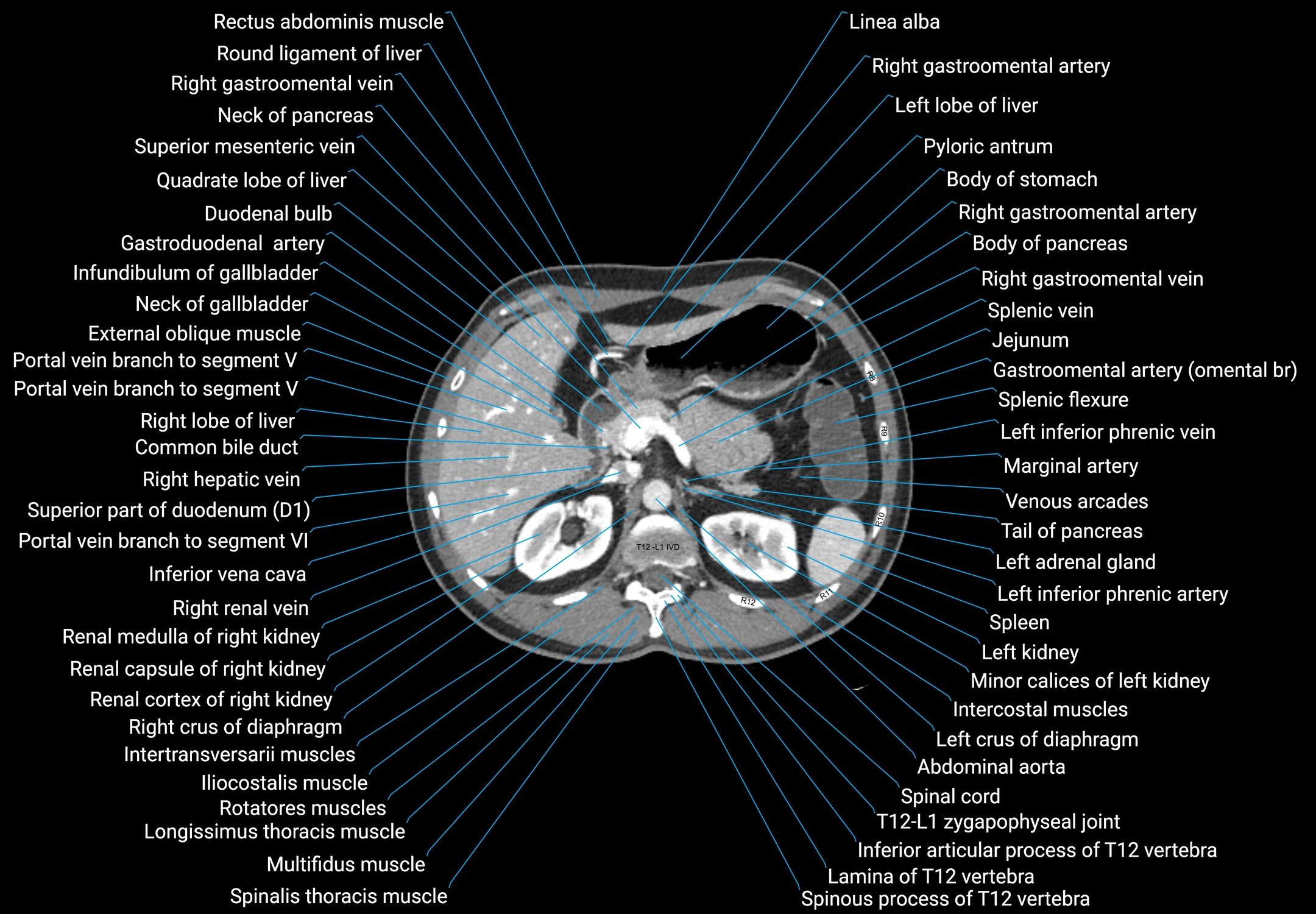 CT male pelvis axial cross sectional anatomy labelled radiology image -00050.webp